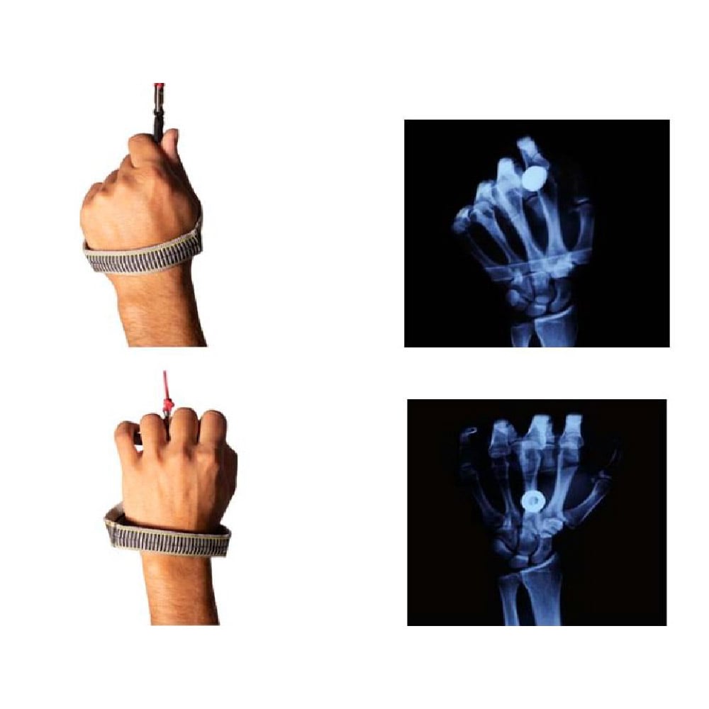 The second X-ray shows a more natural position with Ergo handles.